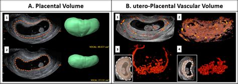 A: Measurement of placental volume (PV, cm³) using 3D ultrasound ...