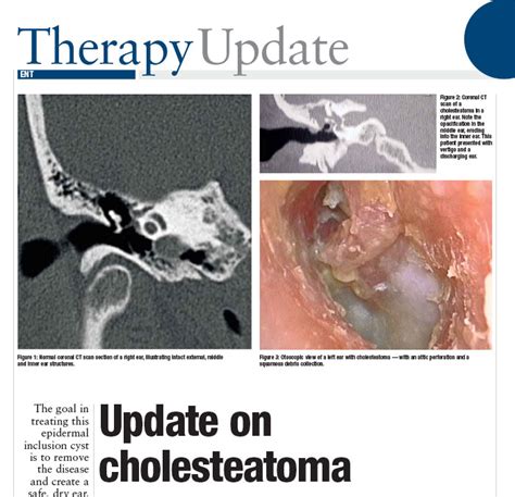 Cholesteatoma - Clinical Prof. Nirmal Patel - ENT Specialist Sydney