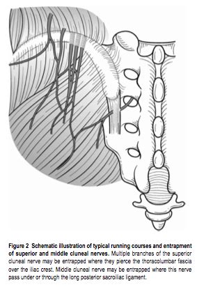 Accurate Education - Low Back Pain: Superior Cluneal Nerve Entrapment (2022)