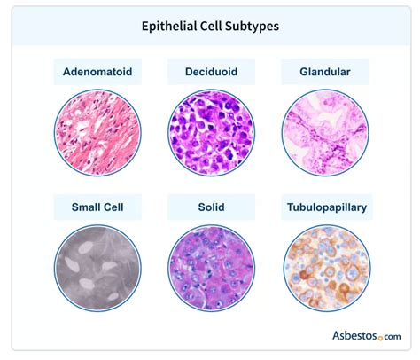 What Is Epithelial Mesothelioma?