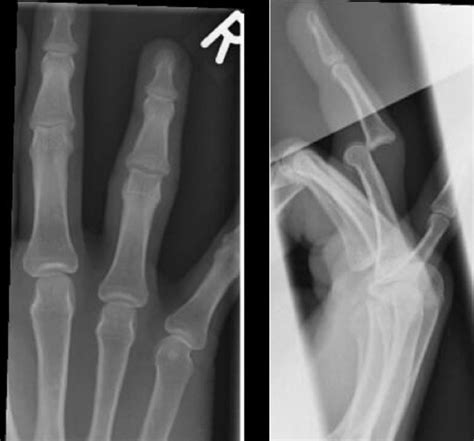 Finger dislocation - Radiology at St. Vincent's University Hospital