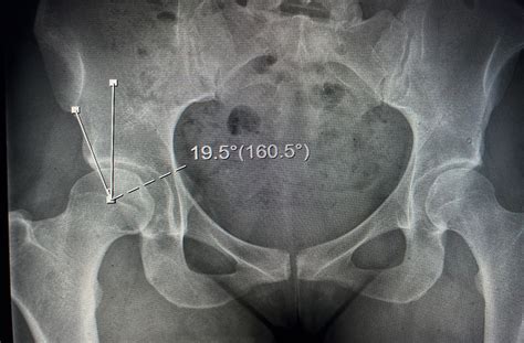 Treating Hip Dysplasia-Associated Labral Tears - Penn Physician VideoLink