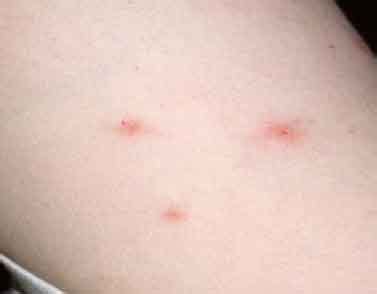 Bed Bug Bite Marks: Body Pictures, Treatment | Free Brochure