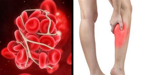 This Video Has The Potential To Save Your Life – How To Spot Blood Clots – Useful Tips for All