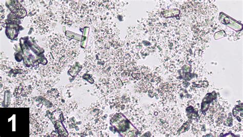 Struvite Crystalluria: Three Cases | Clinician's Brief