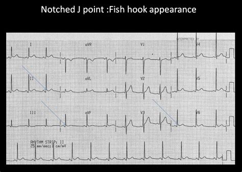 Benign Early Repolarization | Hot topics in emergency medicine