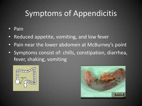PPT - Appendicitis PowerPoint Presentation, free download - ID:4175359