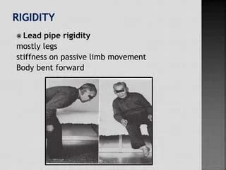 Lead Pipe Rigidity - Type, Treatment, Exercise