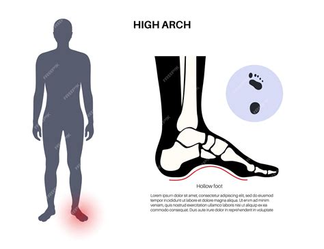 Overpronation Treatment