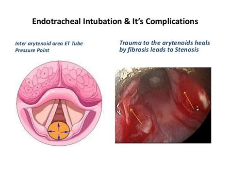 Endotracheal intubation & its complications