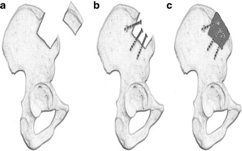 The procedure of reconstruction of the iliac crest after autografting.... | Download Scientific ...