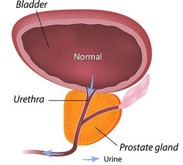 Benign Prostatic Hyperplasia (BPH) | Johns Hopkins Medicine