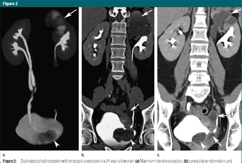 slsi.lk - how long for sulfatrim to work | Mr urogram procedure clearly ...