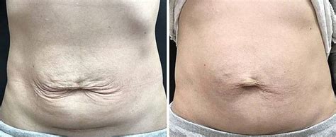 Before And After Thermage For Tummy » Facelift: Info, Prices, Photos ...