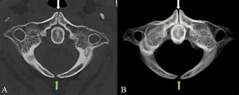 -Case report 2: Nontrauma patient. Noncontrast computed tomography... | Download Scientific Diagram