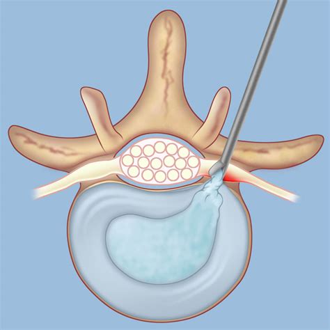 Herniated disk doctor - iheartatila