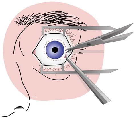 Eye Removal — Current Indications and Technical Tips | IntechOpen