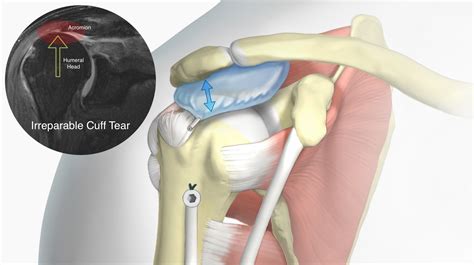 A Balloon for Rotator Cuff Tears? - Shoulder & Elbow