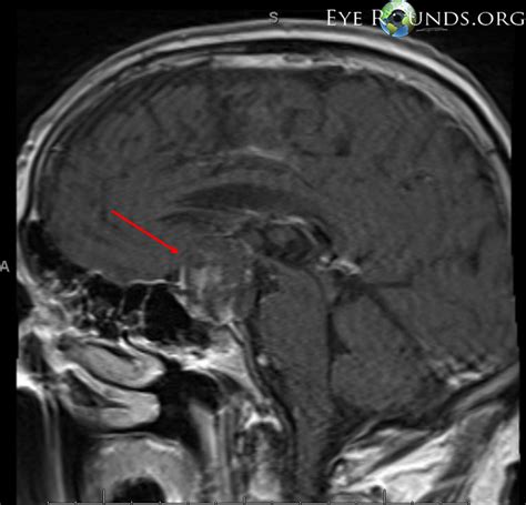 Pituitary Adenoma Causing Compression of the Optic Chiasm: The University of Iowa, Ophthalmology