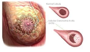 Lobular carcinoma in situ