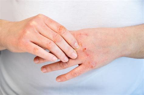 How to Avoid and Treat Dry and Chapped Hands - First Aid for Life