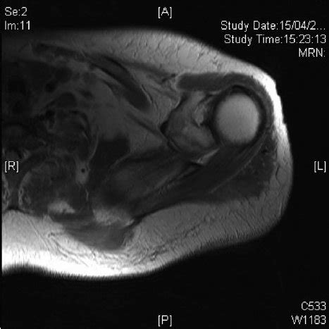 MRI of the patient’s shoulder. Note extensive soft tissue swelling ...