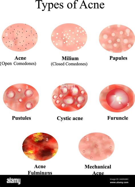 Types of Acne Skin inflammation. Pimples, boils, whitehead, closed ...