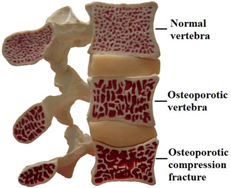 Osteoporotic Fractures – Clínica Neuros | Neurocirujano Valencia