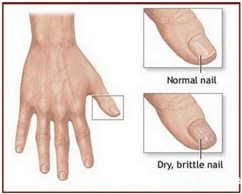 Brittle Toenails - Causes, Treatment and Cure - (updated in 2022)