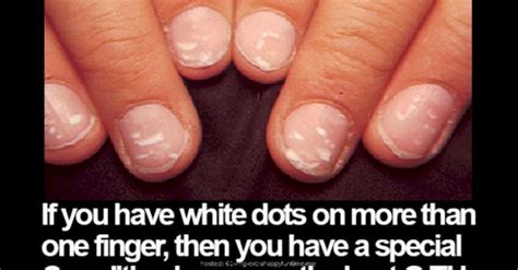 What Causes White Spots On Your Fingernails - Design Talk