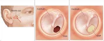 Perforated Eardrum - Symptoms, Causes, Treatment, Antibiotics