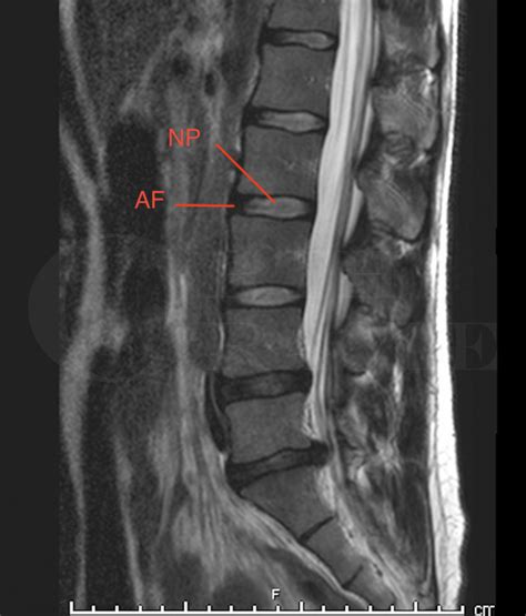 L5/S1 Microdiscectomy Surgical Technique - OrthOracle