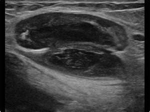 Musculoskeletal Joints and Tendons | 6.5 Hip groin and buttock : Case 6.5.12 Lymph nodes in the ...