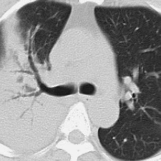 Tram-track sign seen in cylindrical bronchiectasis on the chest CT scan... | Download Scientific ...