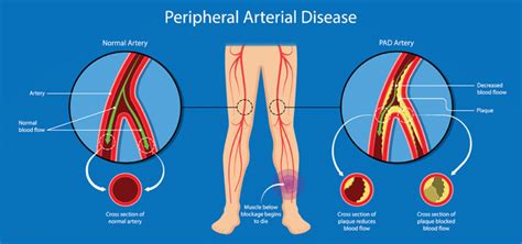 Peripheral Arterial Disease: An under-recognized, slow-burning ...