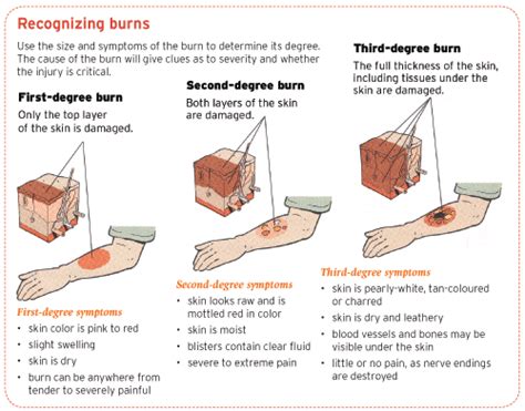 NY Burn Injury Lawyer Explains how Burn Injuries Can Come in Many Forms - Frekhtman & Associates ...