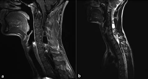 Intramedullary Spinal Cord Tumors | Neupsy Key