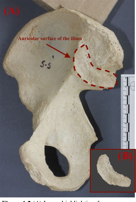 [PDF] Age estimation of the auricular surface of the ilium : a comparison between physical ...