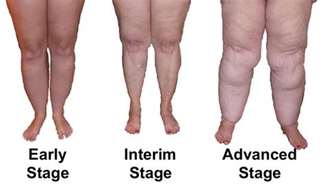 Lipedema is a Medical Condition Often Confused with Lymphedema.