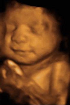 8 3d sonogram ideas | 3d ultrasound, 4d ultrasound, ultrasound