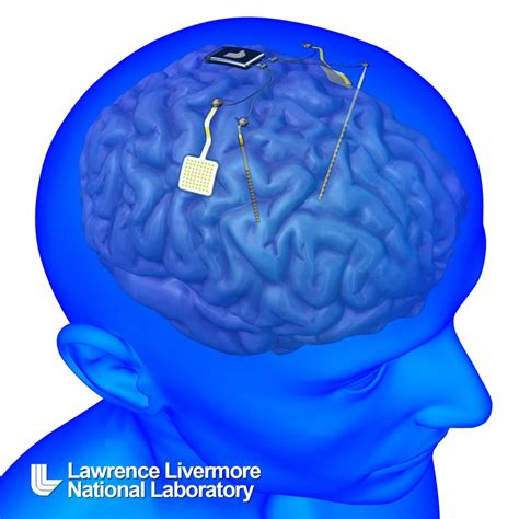 Hacking Brain Disorders Using Neural Implants - Industry Tap