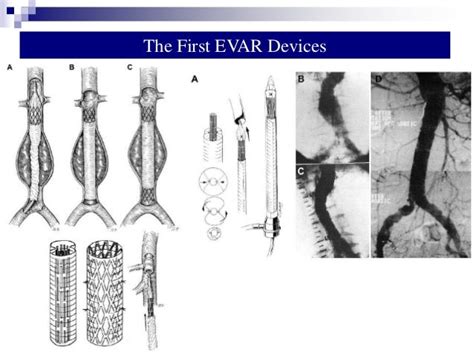 Twenty years of evar in the us the procedure that changed a specialty