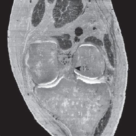 Oblique coronal plane magnetic resonance imaging (MRI) showing the... | Download Scientific Diagram