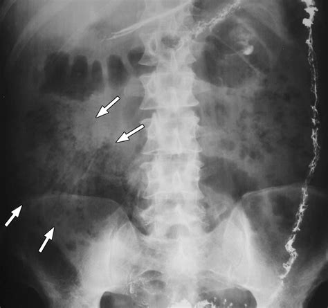 Pneumatosis Intestinalis in the Adult: Benign to Life-Threatening Causes | AJR