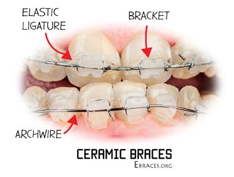 7 Tips to Prevent Ceramic Braces from Staining