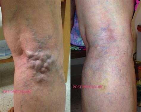 Removal of Varicose Veins | Microphlebectomy in Chesapeake, VA