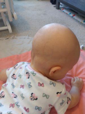 Lumps on back of head | BabyCenter