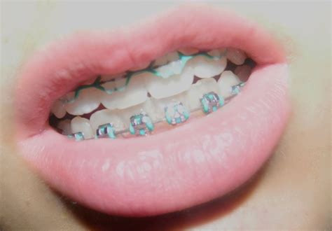 Think what color braces should I get? There are many options available for braces colors, if you ...
