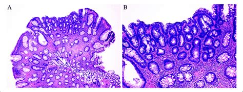 Tubular adenoma. A, Small, pedunculated polyp. B, Crowded,... | Download Scientific Diagram