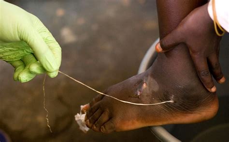 Guinea Worm Closer to Eradication as Cases Halve in a Year – Courthouse News Service